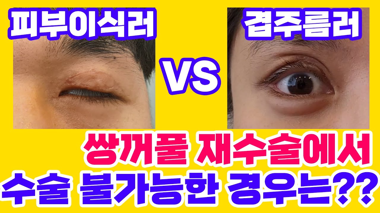 [Ганнам Соён гоо сайхны мэс заслын эмнэлэг] Гоо сайхны зөвлөгөөний төв 💌 | Давхар зовхины давтан мэс засал хийх боломжгүй тохиолдлууд юу вэ?