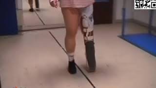 Sexy woman with very short leg and calliper.