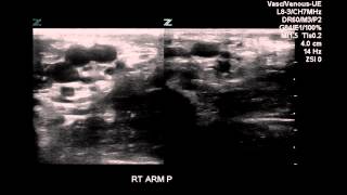 Doppler of Arm With Failed PIC-Line - Case Study