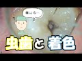 【リクエスト動画】虫歯と着色の見分け方