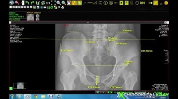 Chiropractic Digital X-ray Software | Ilium Analysis Tool