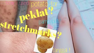 HOW I USED POTATO TO REMOVE MY SCARS/STRETCHMARKS & WHITEN SKIN EFFECTIVELY|100%LEGIT|Ms Sungit