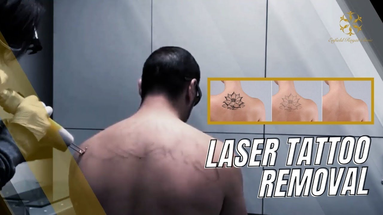 Best Laser Tattoo Removal in Dubai & Abu Dhabi | Dubai - UAE | Cost