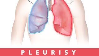 Pleurisy: Causes, Symptoms and Treatment