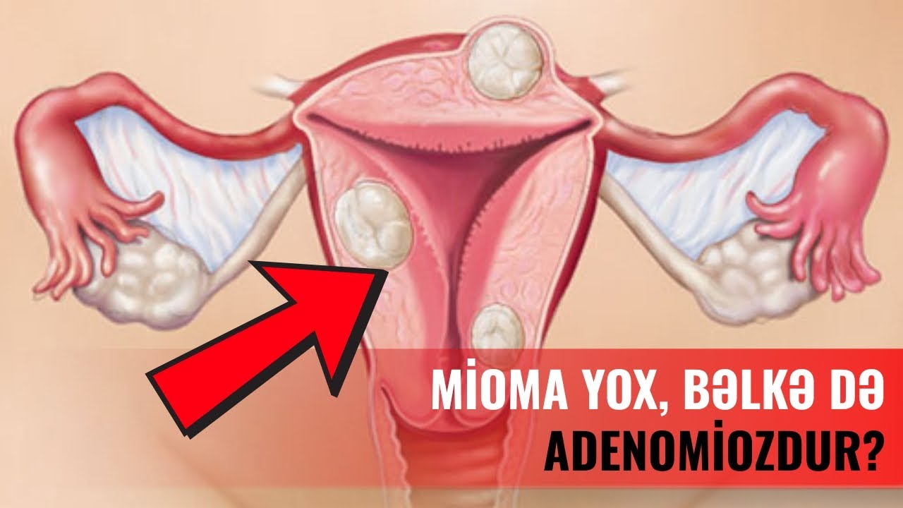 Adenomioz – adını az eşidirik, amma çox qadında rast gəlinir