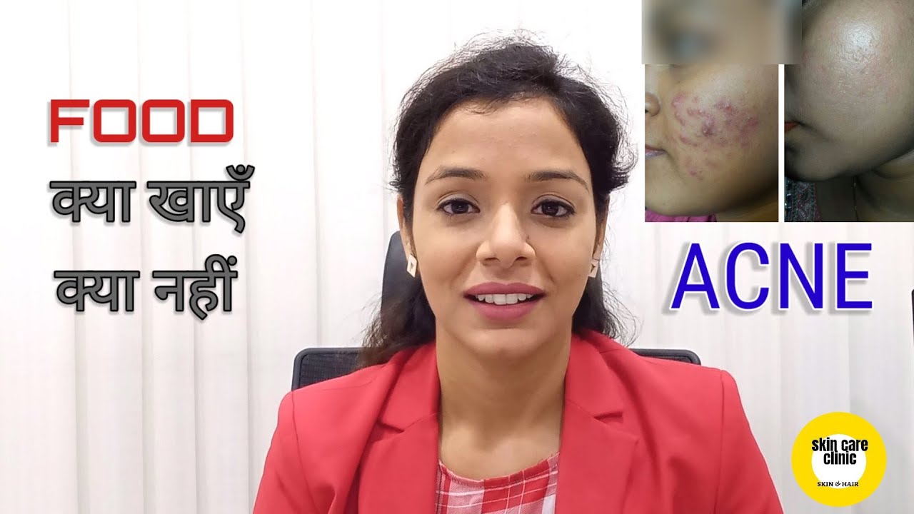 Food Causing Acne l Acne Diet l Vitamins for Acne l Zinc For Acne l Dr