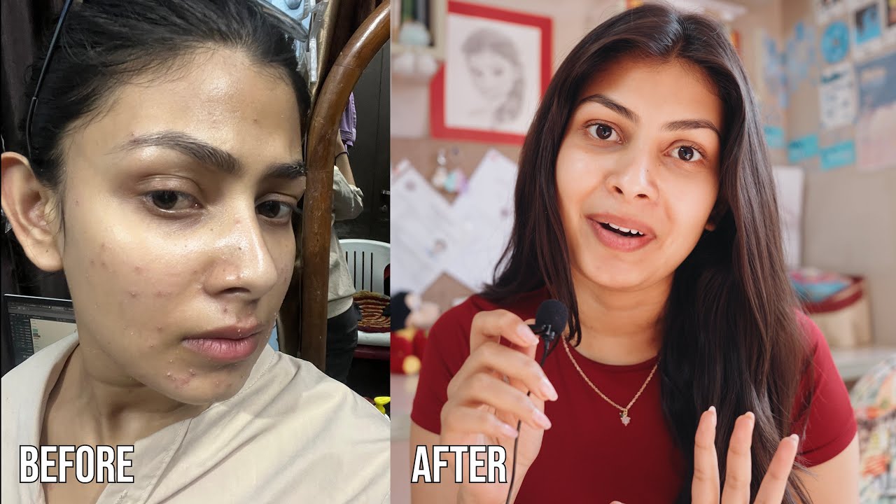 How I Cleared My Acne in 3 Months | My Honest Skin Journey - YouTube