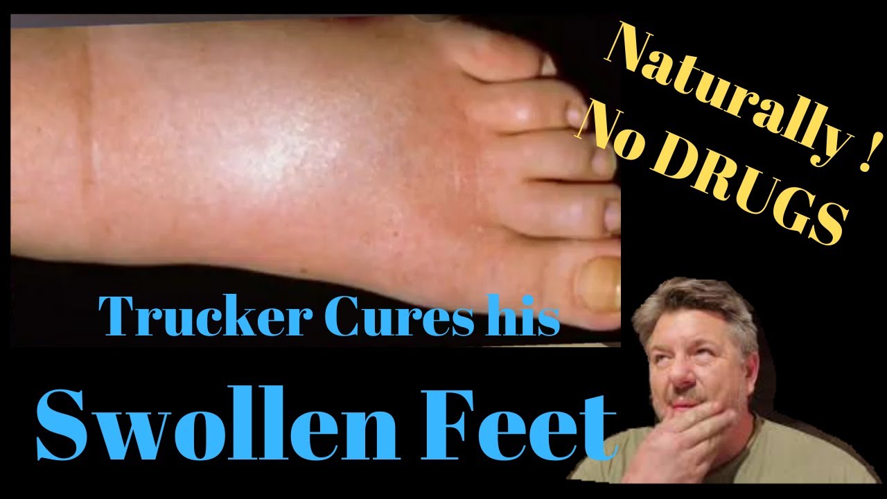 Ric the Trucker cured his swollen feet , fast.