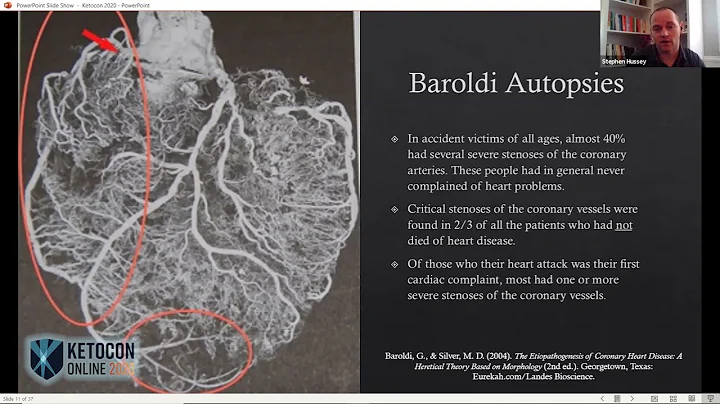 Dr. Stephen Hussey - Ketone Cardiac Metabolism: Why Cancer of the Heart is So Rare