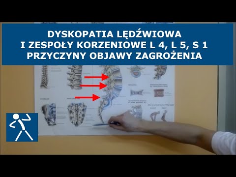 Dyskopatia lędźwiowa | Przepuklina | Zespół korzeniowy L4 L5 S1 | Ból brak czucia niedowład  I 🇵🇱 🇪🇺