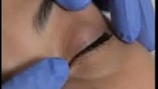 Clinical Observation: REM Sleep Eye Movement Analysis