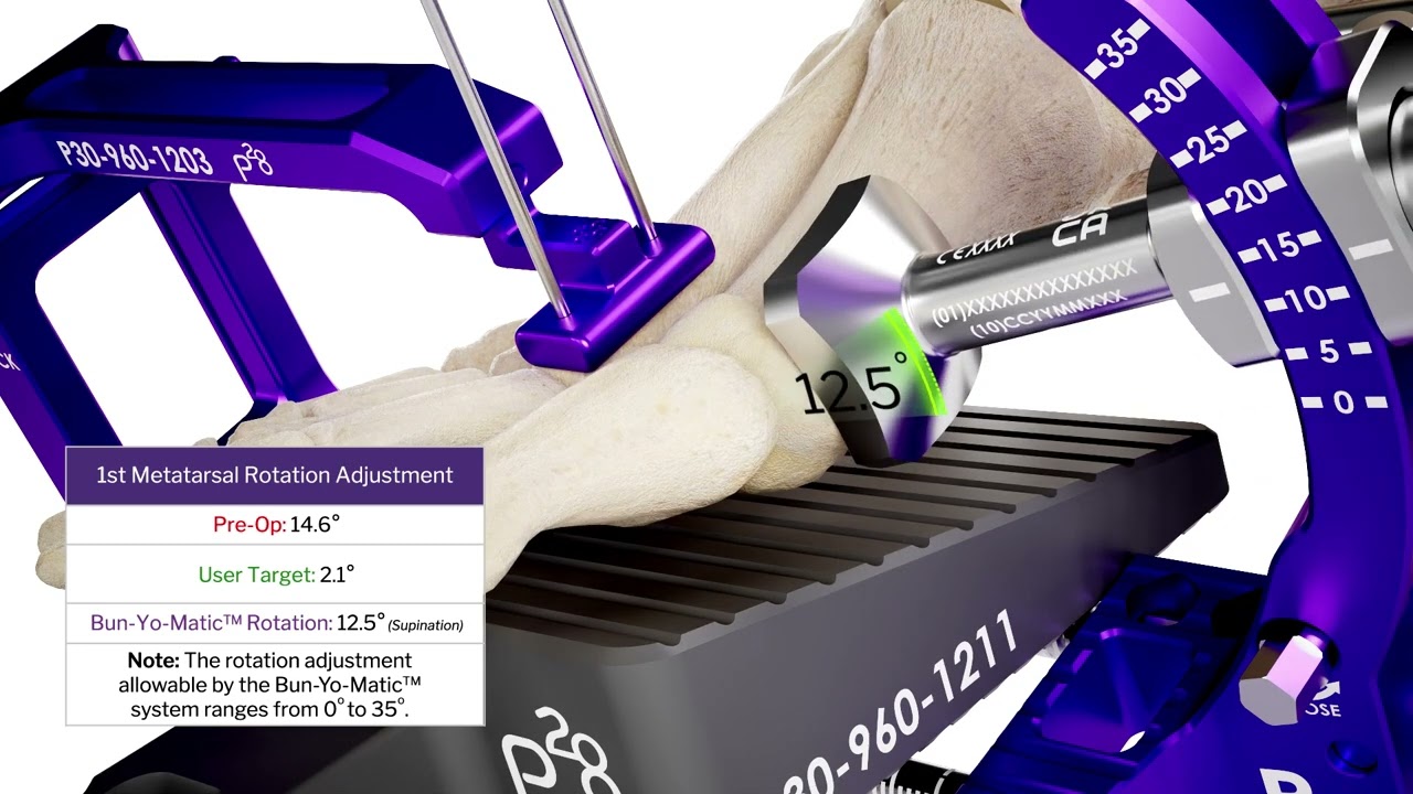 SMART28℠ - SMART Bun-Yo-Matic™ Derotation