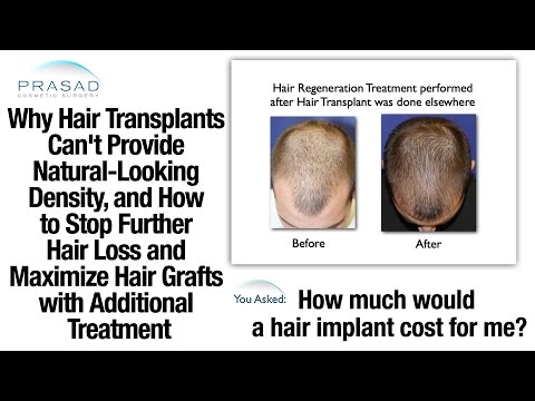 Hair Transplant Alternative that Also Benefits Hair Transplants |TrichoStem