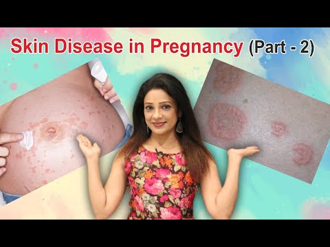 Video: Why pregnant women have a stomach ache: causes and what to do