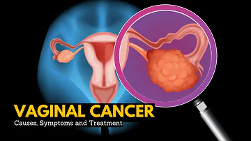 Quali sono i tumori vaginali?