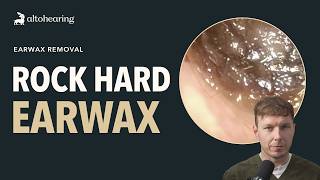 We Tackle A Rock Hard Ear Wax Plug.