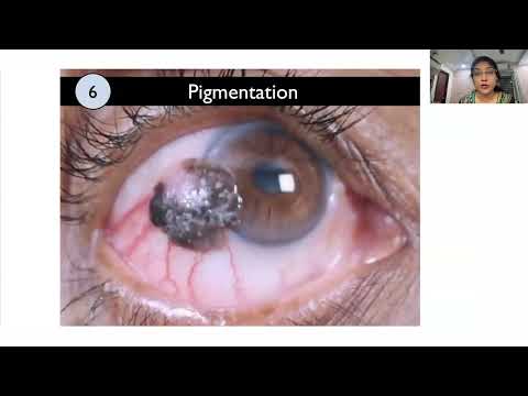 Lecture A To Z Of Ocular Surface Squamous Neoplasia