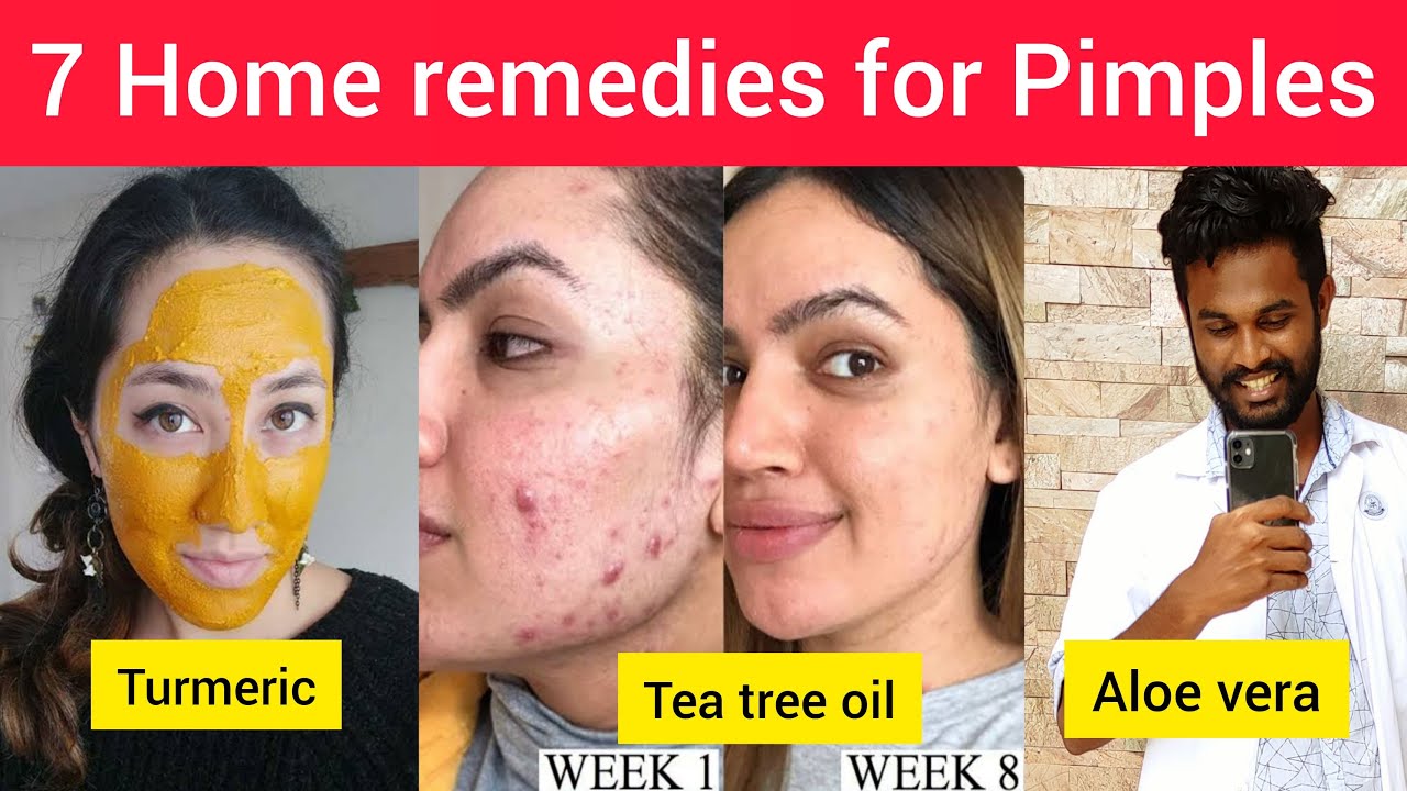 Top 7 Home remedies for Pimples 🥵 Natural ways to get rid of pimples 