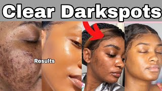 You Will Never Use Make-Up Again, How To Remove Black Spots.