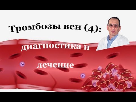 Тромбоз вен (4): Диагностика и лечение венозного тромбоза. Знания для ВСЕХ.