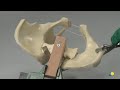 AOTrauma Player   Pelvis–Sacroiliac joint and pubic symphysis disruption