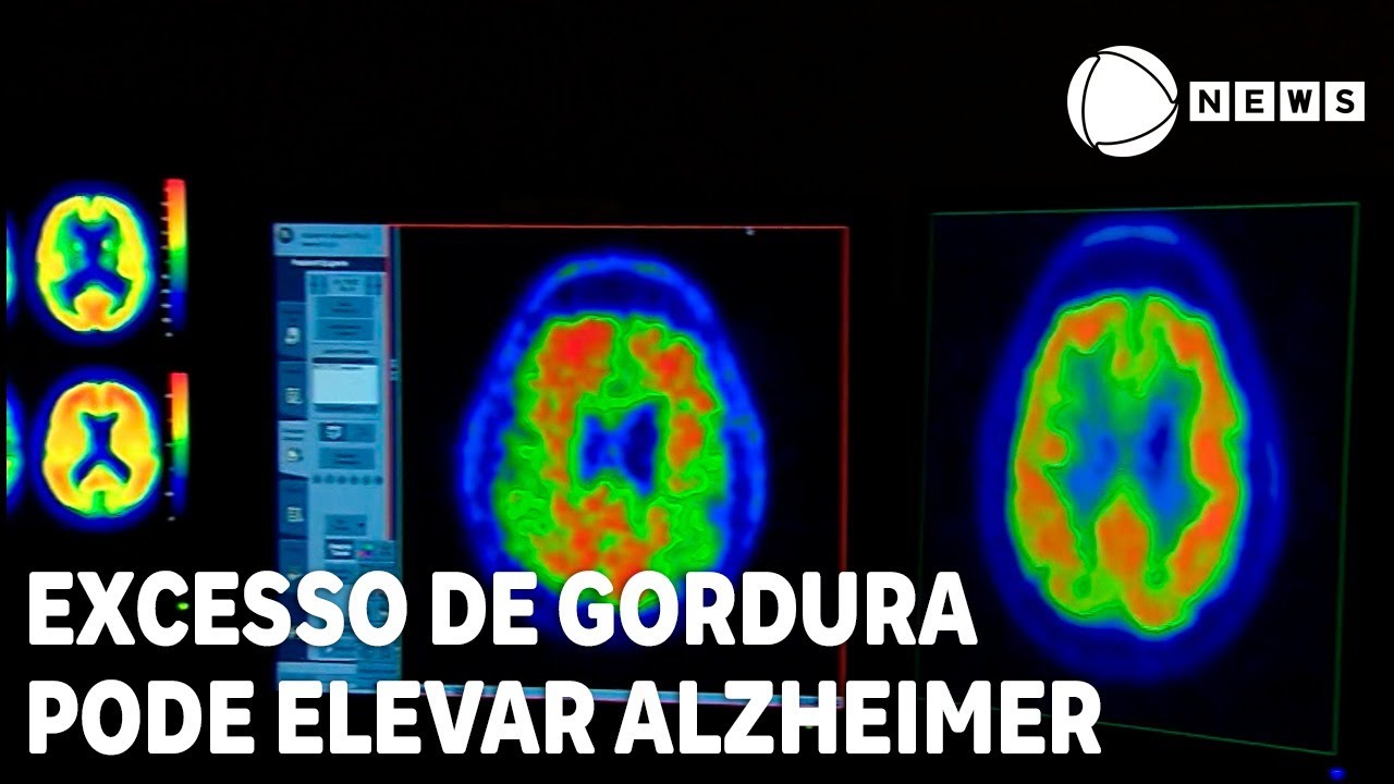 Excesso de gordura abdominal pode elevar chance da Alzheimer