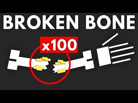 How Many Times Can You Break The Same Bone Safe Videos For Kids - dantdm roblox broken bones