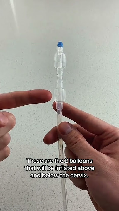 How Labor Is Induced (Pregnancy Induction Methods) - Cervical Ripening Cook Balloon