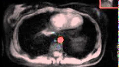 MedVoxel Cardiac MRI Real-time Flow Contrast Contour / Segmentation Demo