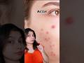 Biocule NoMoreAcne Serum #antiacne #faceserum #oilyskincare #oilyskincareroutine #oilyskincaretips