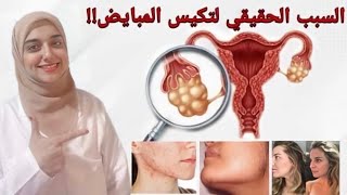 علاج تكيس المبايض نهائيا في ٣ خطوات ...