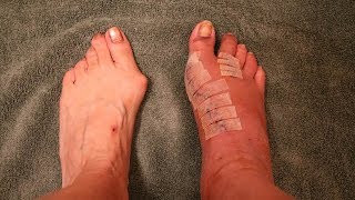 BUNION SURGERY - GOT THE STITCHES OUT & SOME BAD NEWS