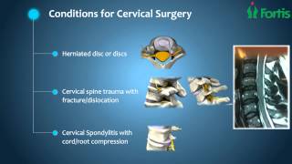 Anterior Cervical Discectomy Fusion Spine Surgery Neuro Surgery Fortis Healthcareindia