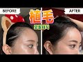 【한일부부/日韓夫婦】ヘアライン植毛Vログ/드디어 머리를 심었습니다
