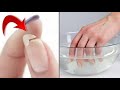 Как укрепить ногти йодом