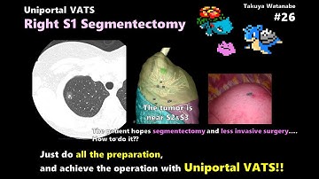 No.26 Uniportal VATS Right S1 Segmentectomy　単孔式胸腔鏡下右肺S1区域切除術【高画質HD】