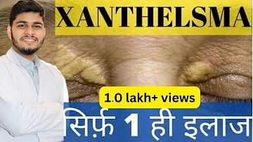 आंखों के पास पीले चकत्ते पड़ जाएंगे अगर ये गलतियां जारी रखीं | Xanthelasma|Cholesterol