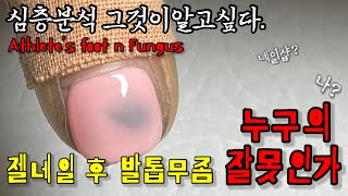 젤네일 후 무좀발톱 왜 생길까? 이유를 알아야 피할 수 있다!! 심층분석/ 무좀발톱 누구의 잘못인가