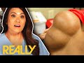 Dr. Lee Discovers What Caused This Fluid Mass On Delano’s Back! | Dr. Pimple Popper: This Is Zit