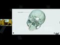 How NewBoard E55" Visualizes Complex Medical Charts for Pathology Lectures (Part 1)