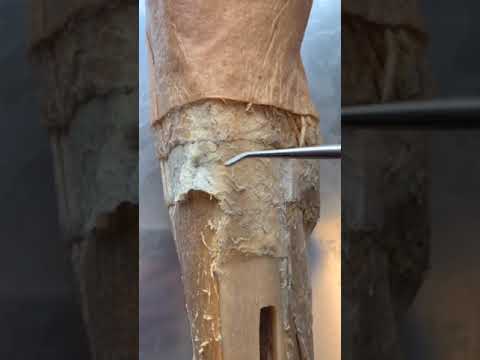 वीडियो: क्या पिंडली की मोच को छूने से दर्द होता है?