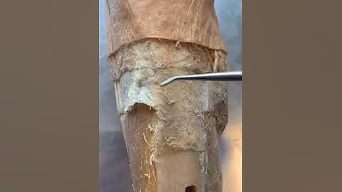 THIS Is What Shin Splints Are