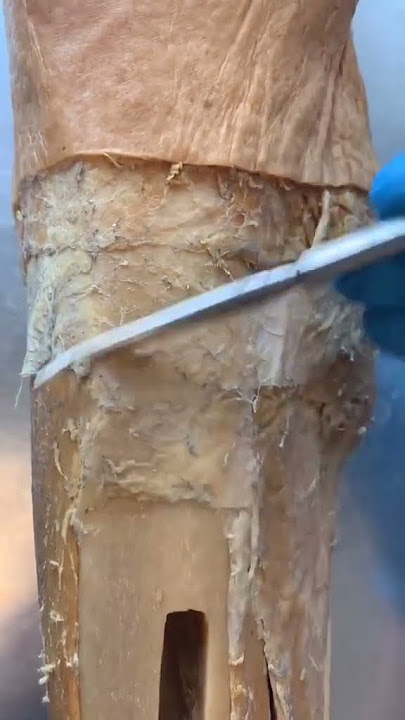 THIS Is What Shin Splints Are