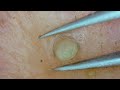 0331 keratin plug removal nose