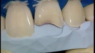 Реставрация фронтальных групп зубов