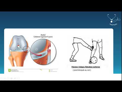 Vidéo: Entorse Et Blessure Du Ligament Collatéral Latéral