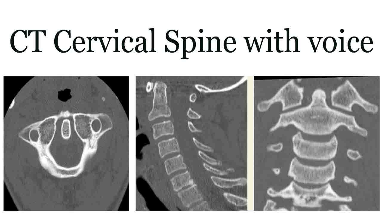 How To Read A Ct Scan Of The Cervical Spine