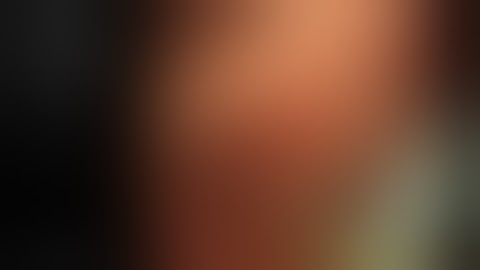 severe cholangitis, very large CBD stone, ERCP