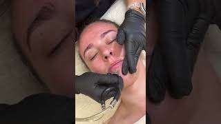 Microderm Infusion Facial Treatment ✨ #yyc #microdermabrasion #facialtreatment #facial  #skin