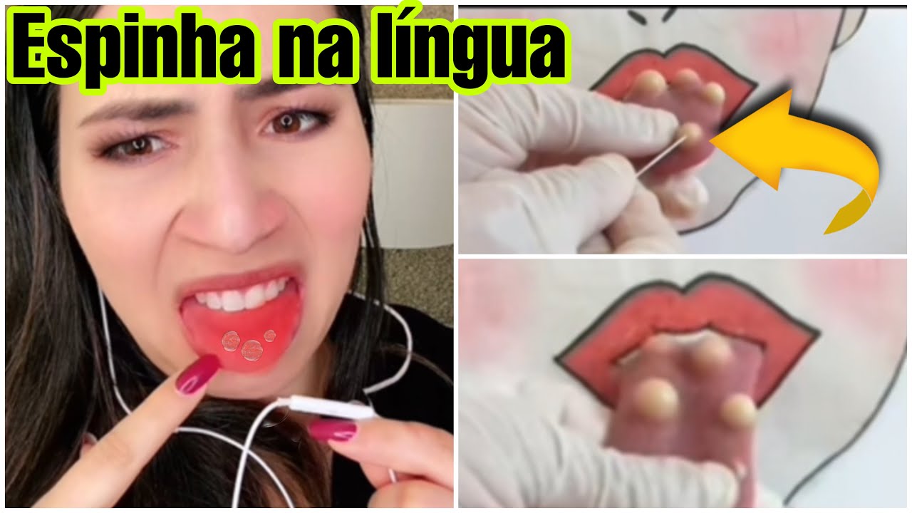 Espinha Na Língua Como Tratar - RETOEDU